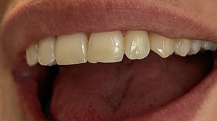 Antes: diente frontal superior despostillado